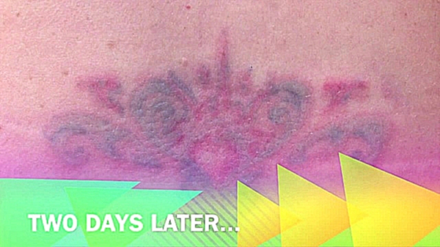 Tattoo Removal is Now So Easy with Vero Cosmetic and Medispa 